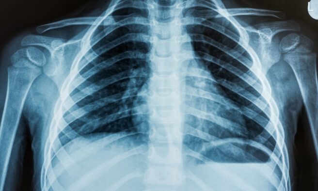 OTD in 1896: College students illegally produced America’s first X-ray photo.